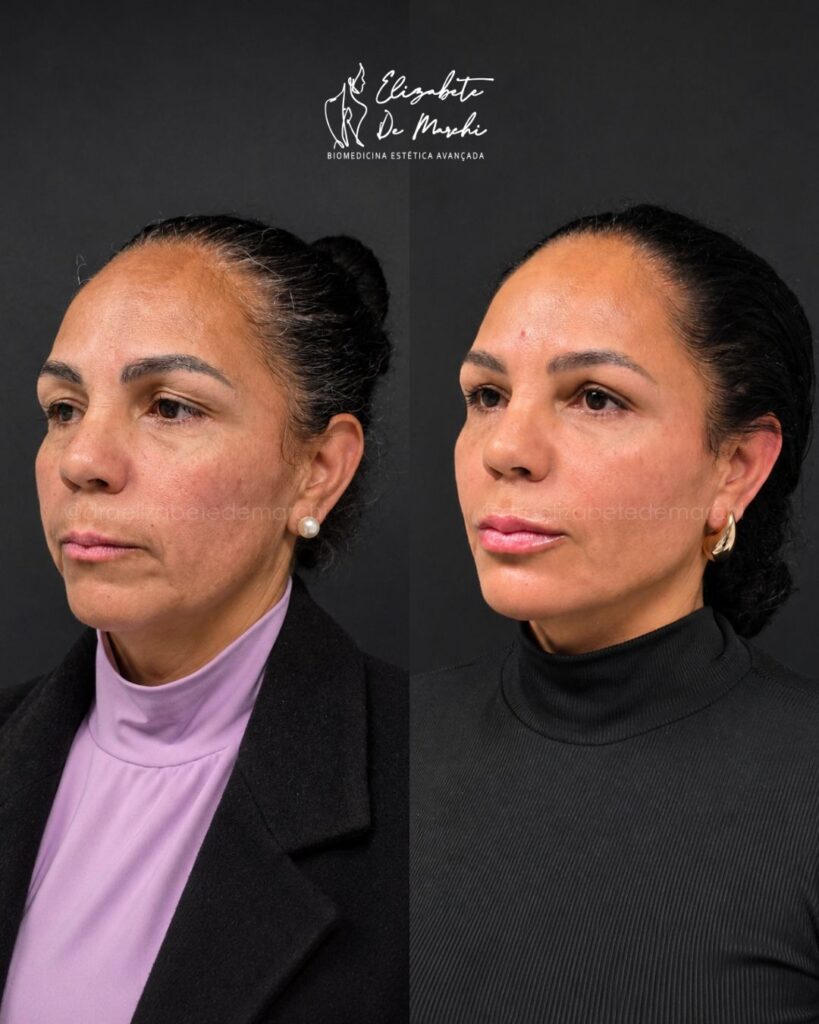 Dra Elizabete De Marchi Metodo De Marchi full face 819x1024