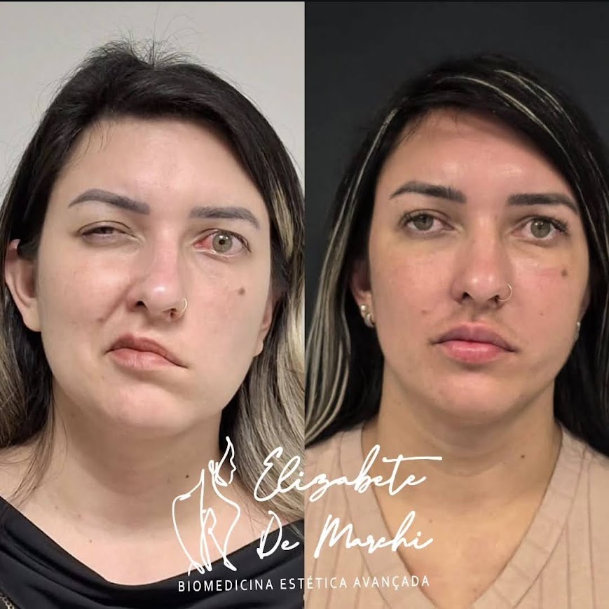 Antes e Depois do Metodo De Marchi Full face