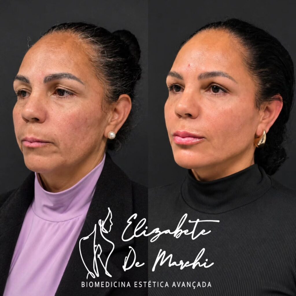 Dra. Elizabete De Marchi full face antes e depois 1024x1024